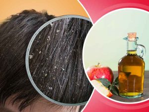 وصفة خل التفاح للتخلص من قشرة الشعر نهائيًا