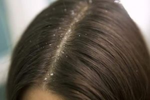 الثوم للتخلص من قشرة الشعر والنتيجة مذهلة